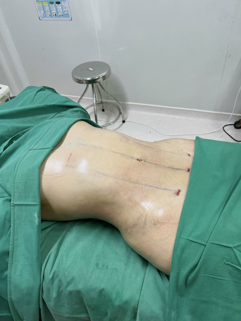 Trước khi hút mỡ bụng, đừng bỏ qua 7 rủi ro quan trọng này
