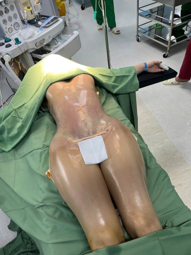 Sau hút mỡ bụng bao lâu mới sinh hoạt bình thường và thấy rõ kết quả?
