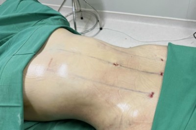 Cần Biết Gì Trước Khi Hút Mỡ? 7 Điều Quan Trọng