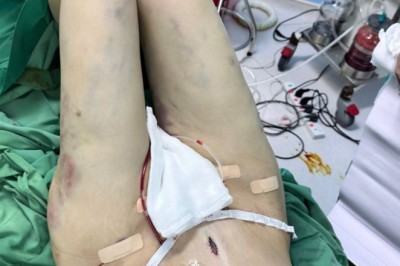 Chuyện chưa kể hút mỡ đùi: Khi bạn muốn tự tin hơn với vóc dáng