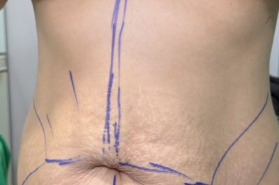 Chuyện chưa kể về hút mỡ: Những điều ít ai chia sẻ