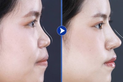 Hành trình nâng mũi – Thay đổi đường nét, hài hòa gương mặt