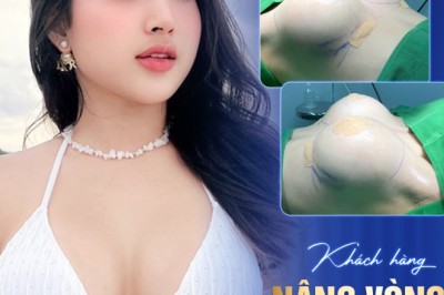 Hành trình nâng ngực – Từng bước thay đổi vóc dáng