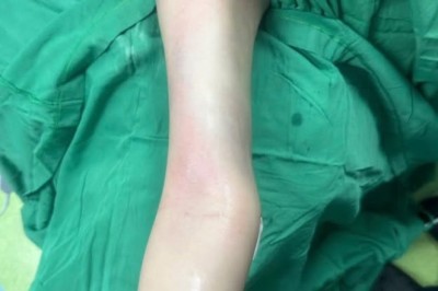 Hút mỡ cánh tay – Chú trọng đường nét, hài hòa vóc dáng