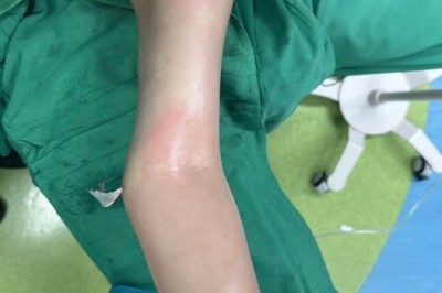 Hút mỡ cánh tay – Cải thiện đường nét, hài hòa vóc dáng