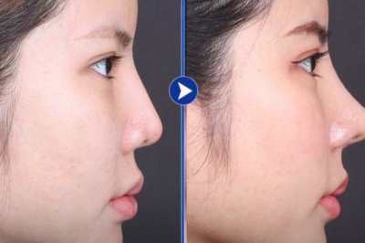 Nâng mũi thẩm mỹ – Khám phá hành trình làm đẹp tại Sao Hàn