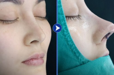 Nâng mũi thẩm mỹ – Tìm dáng mũi đẹp tự nhiên với gương mặt