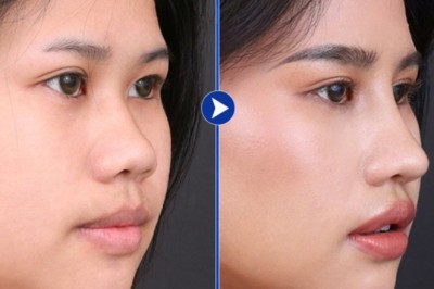 Nâng mũi thẩm mỹ – Tìm dáng mũi hài hòa với gương mặt