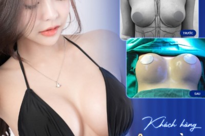 Nâng ngực thẩm mỹ – Cải thiện vóc dáng, tôn đường cong