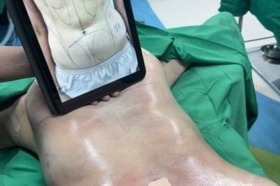 BÊN TRONG MỘT CA HÚT MỠ THỰC TẾ CÓ GÌ?