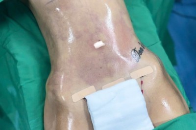 10 điều cần biết trước khi thẩm mỹ hút mỡ an toàn