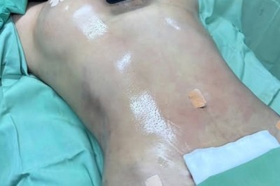 Điều kiện an toàn khi hút mỡ: 7 điều cần kiểm tra trước khi làm