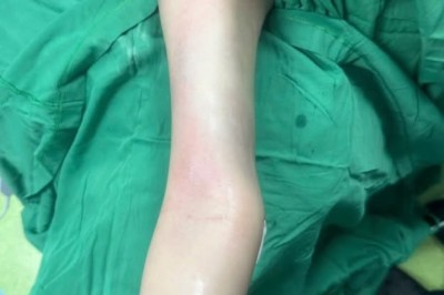 Hành trình hút mỡ bắp tay sau: Tìm hiểu giải pháp giúp cánh tay trông thon gọn hơn