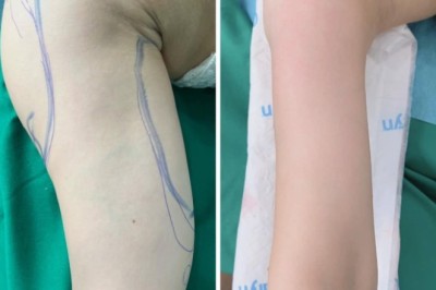 Hành trình hút mỡ bắp tay: Tự tin diện váy áo, khoe nét đẹp riêng