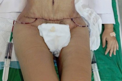 Hành trình hút mỡ bụng dưới: Tìm hiểu giải pháp cải thiện vùng bụng khó giảm