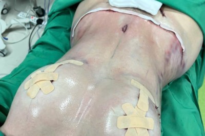 Hành trình hút mỡ bụng và tạo dáng body: Tìm hiểu giải pháp cải thiện vóc dáng sau giảm cân