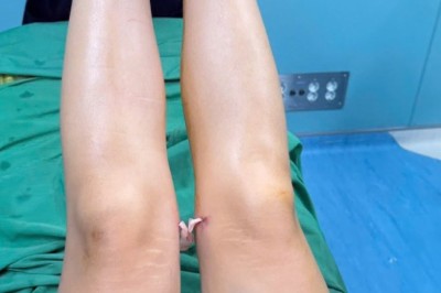 Hành trình hút mỡ đùi: Tự tin với từng bước chân, thoải mái diện trang phục yêu thích