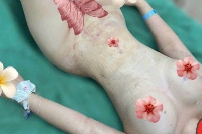 Hành trình hút mỡ hông: Cải thiện đường nét body, tự tin với phong cách riêng
