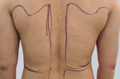 Hành trình hút mỡ lưng: Tạm biệt nỗi lo ngấn mỡ, tự tin diện mọi phong cách