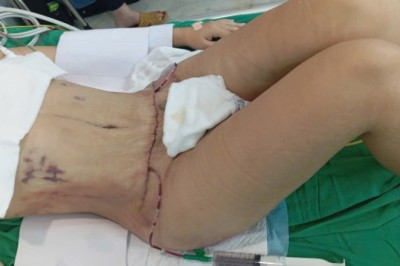 Hành trình hút mỡ mu: Khi bạn muốn tự tin hơn với vùng đùi trong