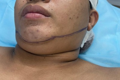 Hành trình hút mỡ nọng cằm: Gương mặt thanh thoát hơn, tự tin từ mọi góc nhìn