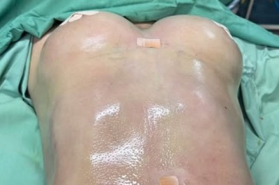 Hành trình hút mỡ sau sinh: Tìm lại sự tự tin, yêu thương bản thân nhiều hơn