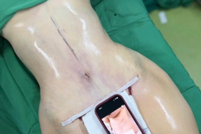 Hành trình hút mỡ toàn thân: Khi bạn muốn thay đổi đường nét vóc dáng
