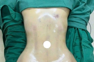Hút mỡ bao lâu thì hồi phục? Các mốc cần biết sau phẫu thuật