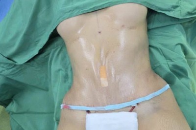 Hút mỡ bụng có để lại sẹo không? Vị trí và cách chăm sóc