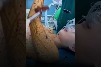 Hút mỡ cánh tay có để lại sẹo không? Vị trí và cách chăm sóc