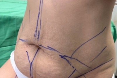 Hút mỡ có bị béo lại không? Những điều cần biết sau hút mỡ