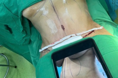 Hút mỡ có đau không? Mức độ đau và cách chăm sóc sau hút mỡ