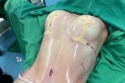 Hút mỡ có để lại sẹo không? Những điều cần biết trước khi làm