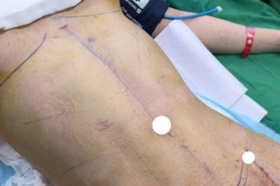 Kinh nghiệm hút mỡ: 12 điều cần biết trước, trong và sau khi thực hiện