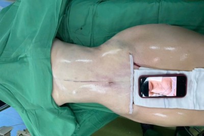 Kinh nghiệm hút mỡ bụng: 8 điều cần chuẩn bị để tránh kỳ vọng sai
