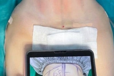 Kinh nghiệm hút mỡ từng vùng cơ thể và những lưu ý quan trọng
