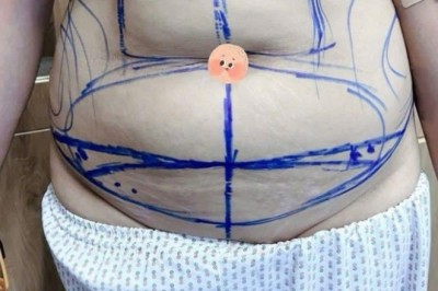 Tâm sự hút mỡ bụng: Mình sợ nhất là người khác nghĩ mình lười, nhưng chẳng ai biết mình đã cố gắng thế nào