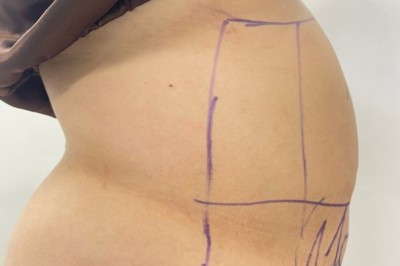 Tâm sự hút mỡ: Giảm cân được rồi mà sao hai bên eo vẫn cứ làm mình mất tự tin?