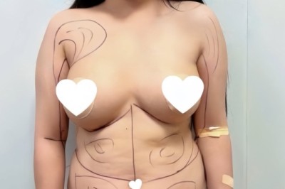 Tâm sự hút mỡ: Mình sợ nhất là giảm cân mãi mà vóc dáng vẫn không như mong muốn