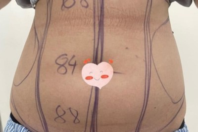 Tâm sự hút mỡ: Sau khi sinh con, mình không còn dám mặc chiếc áo croptop từng rất thích