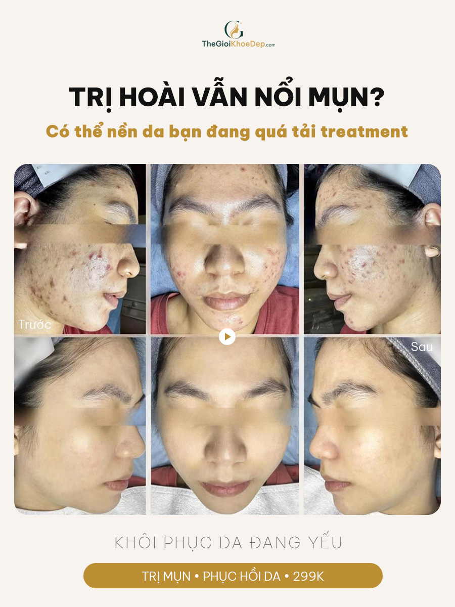 Những điều người bị mụn lo sợ