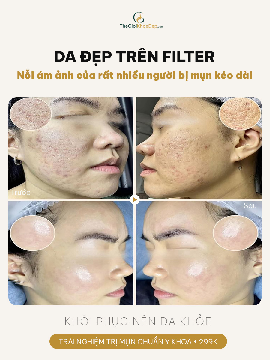Sai lầm khi trị mụn viêm