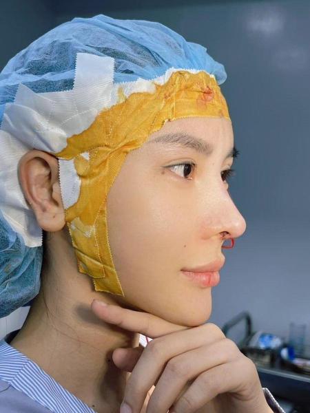 Nâng Mũi Cấu Trúc S-Line Megaderm