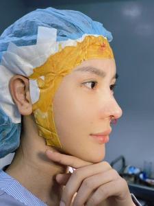 Nâng Mũi Cấu Trúc S-Line Megaderm