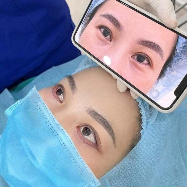 Điều trị sụp mí - 1/3