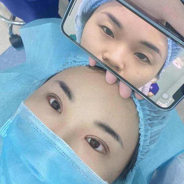 Cắt mắt 2 mí cấu trúc - 3/3