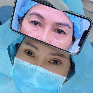 Cắt mắt 2 mí Hàn Quốc