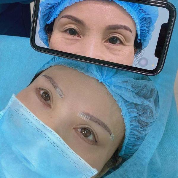 Cắt mắt 2 mí Hàn Quốc - 2/3