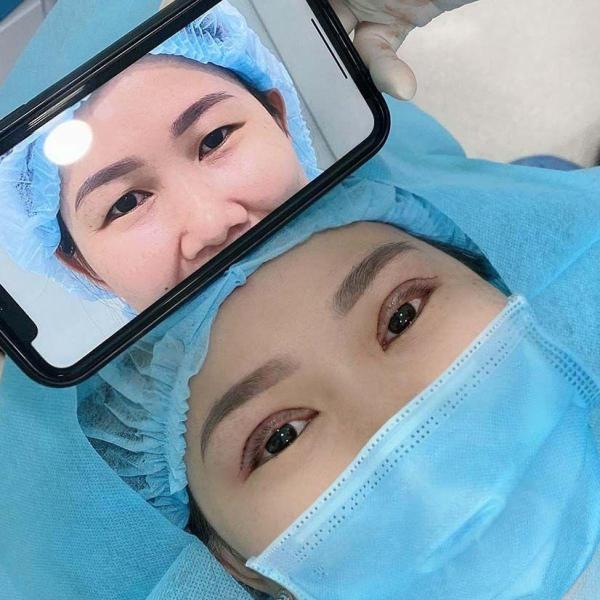 Thẩm mỹ mắt to - 1/3