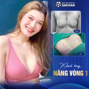 Chỉnh hình ngực xệ – Mức 4